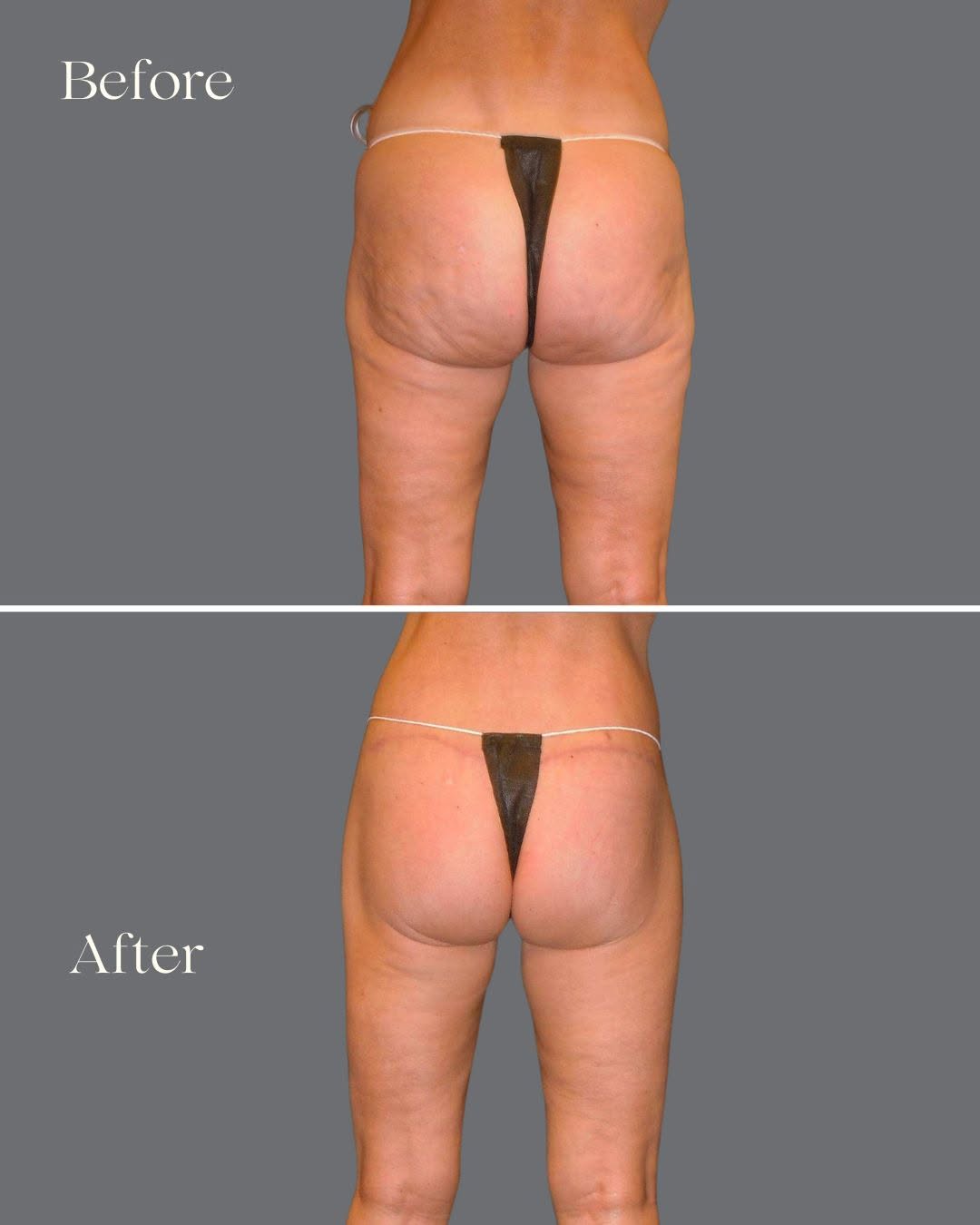 Instagram post by Dr. Kimball M. Crofts: Lower Body Lift with Board Certified Plastic Surgeon Dr. Crofts. Designed to address loose, sagging skin after significant weight loss, agin…