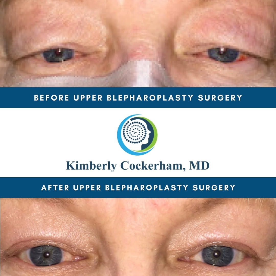 Instagram post by Dr. Kimberly P. Cockerham: Here is another great Before & After of an Upper Blepharoplasty Surgery! Check out my actual patient's amazing results. This eyelid surgery …