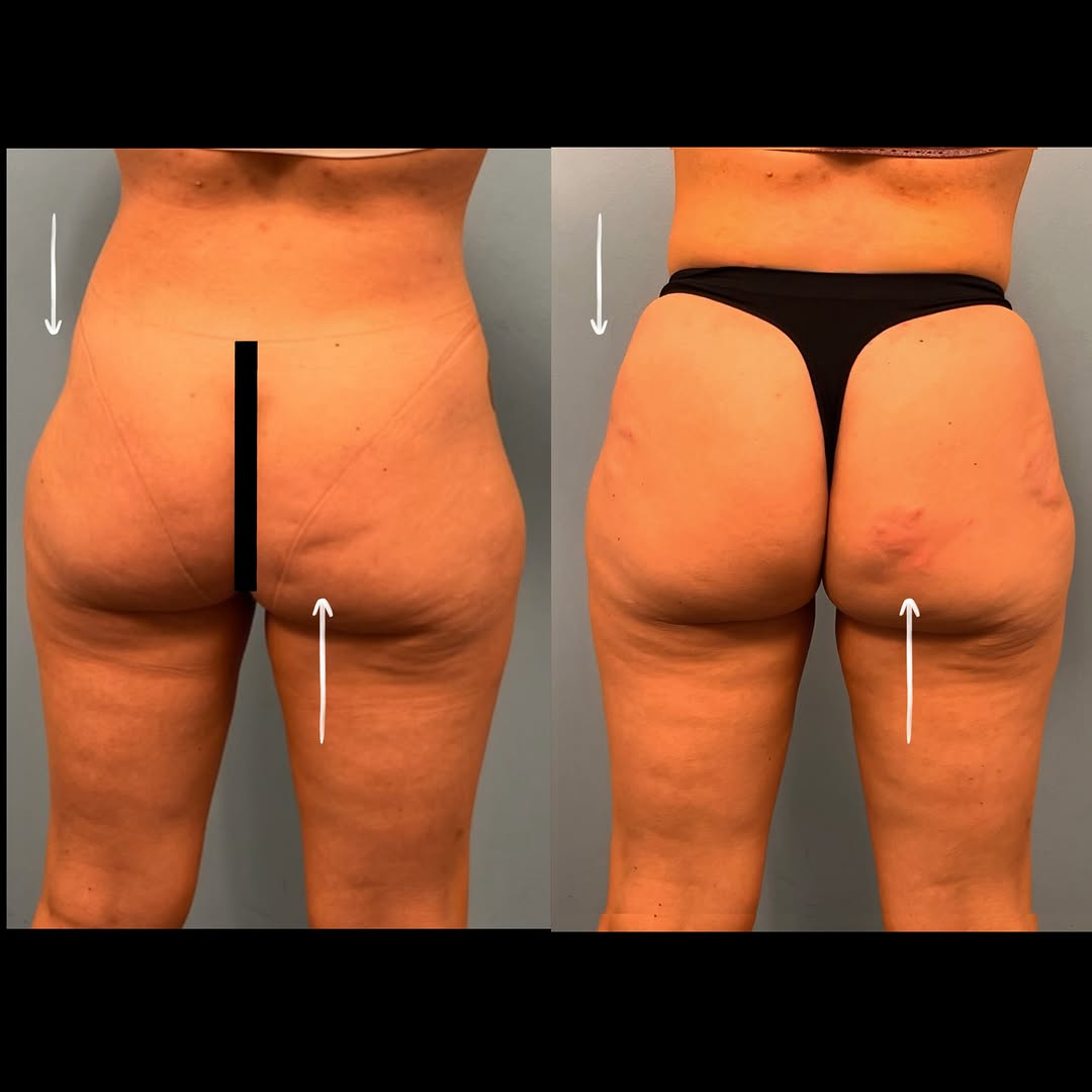 Instagram post by Dr. Kimberly Short: ✨ Non-Surgical BBL with Radiesse ✨ Instant volume, smoother contours, and improved skin texture—without surgery. 🤍 This patient chose a Rad…