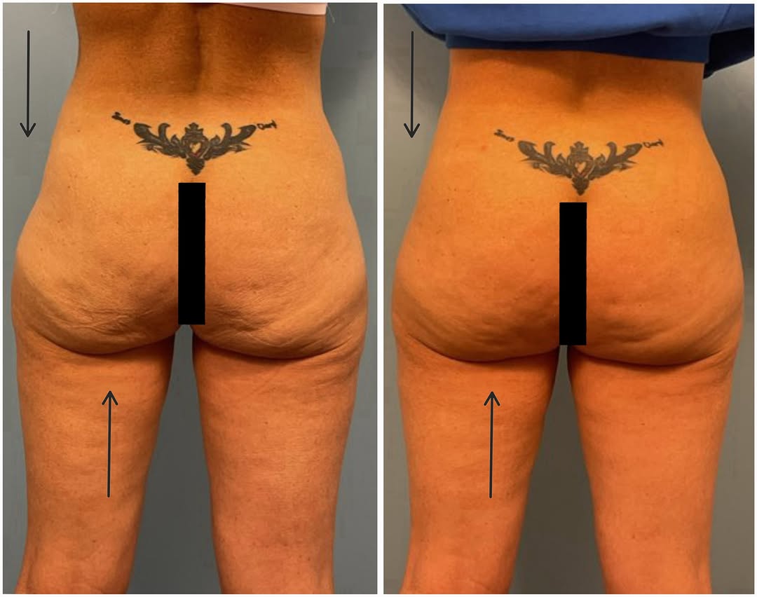 Instagram post by Dr. Kimberly Short: Before➡️ After🍑 Natural-looking enhancement without surgery.✨ This patient’s non-surgical BBL using Radiesse® helped improve the appearance…