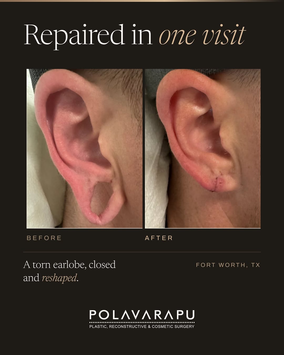 Instagram post by Dr. Kiran Polavarapu: Years of heavy earrings, a stretched piercing, or an injury can gradually thin and elongate the earlobe, widening the opening until it no lo…