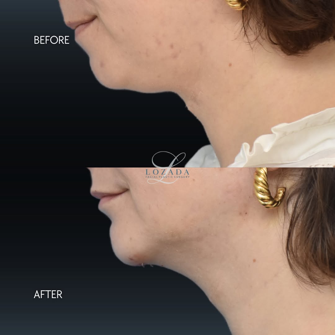 Instagram post by Dr. Kirk Lozada: Chin implant + neck liposuction transformation ✨ A well-defined chin and jawline can create balance and harmony throughout the entire face. …