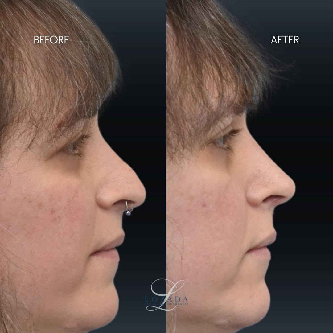 Instagram post by Dr. Kirk Lozada: 6 weeks after rhinoplasty and this transformation is already taking shape ✨ This patient came in with concerns of a drooping tip and desired…