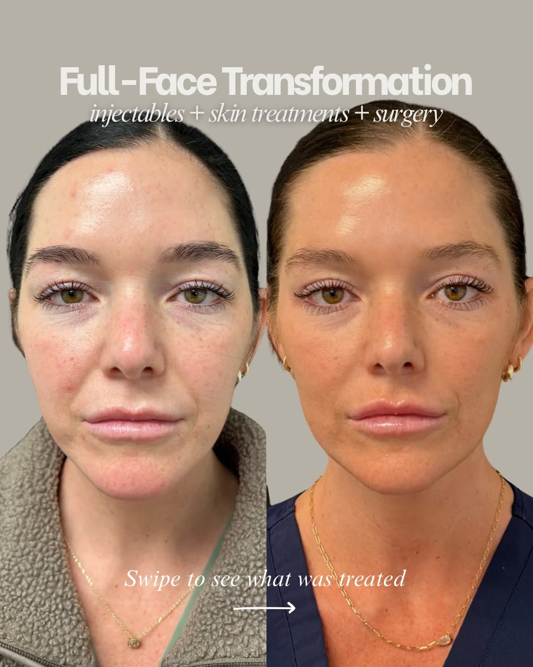 Instagram post by Dr. Kirk Lozada: Full-face rejuvenation isn’t about one treatment - it’s about developing a comprehensive plan that considers the face as a whole This transf…