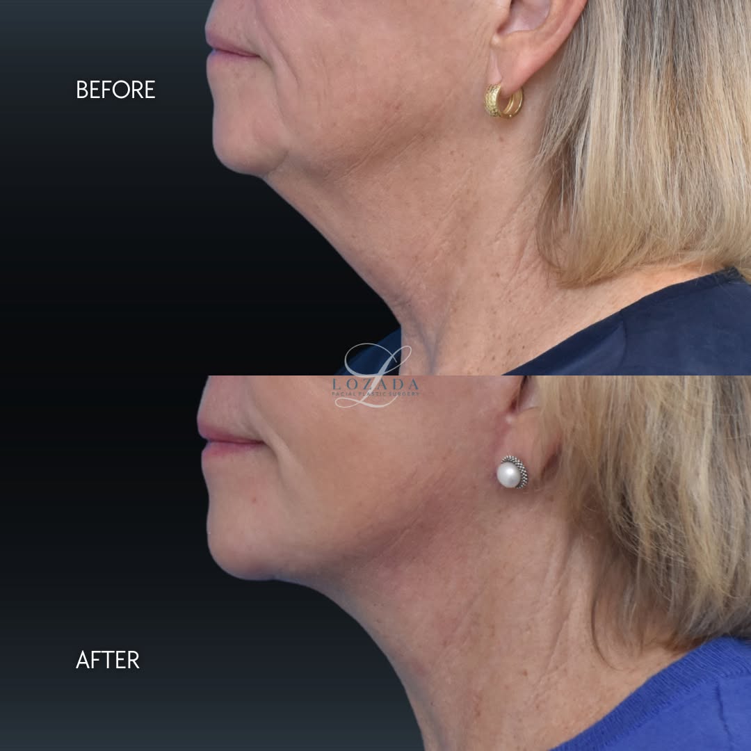 Instagram post by Dr. Kirk Lozada: One of the biggest changes we see with facial aging is the loss of definition along the jawline and neck. With a face lift and deep neck lif…