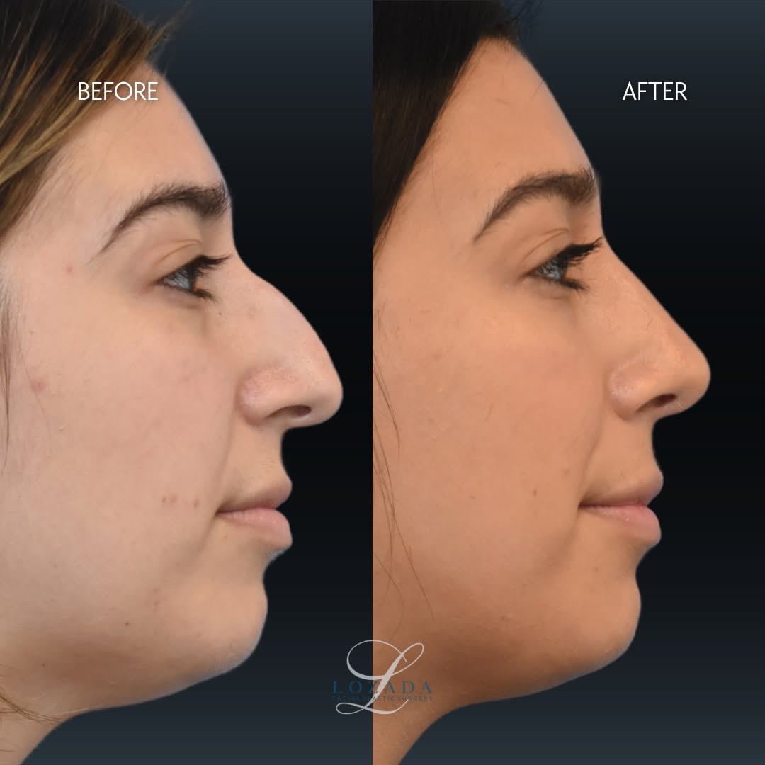 Instagram post by Dr. Kirk Lozada: A beautiful rhinoplasty transformation ✨ For this patient, the goal was to smooth that dorsal hump and straighten the nasal bridge. The resu…