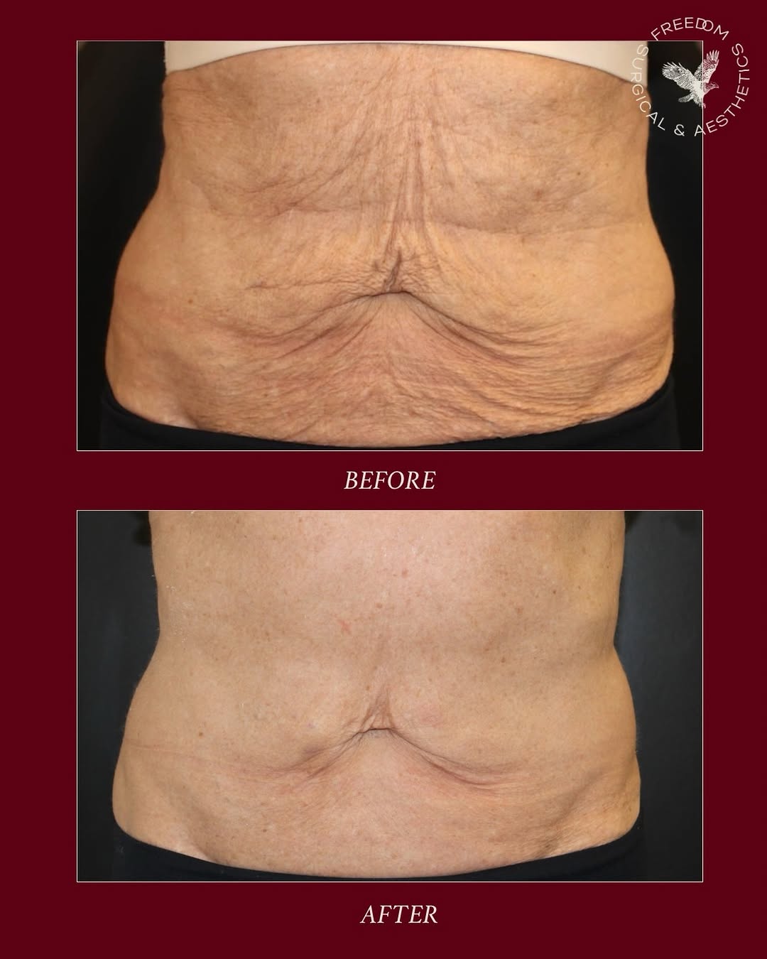 Instagram post by Dr. Kirk Moore: THREE XERF TREATMENTS. ✨ No surgery. No needles. Just progressive skin tightening you can actually see. This before & after shows what’s pos…
