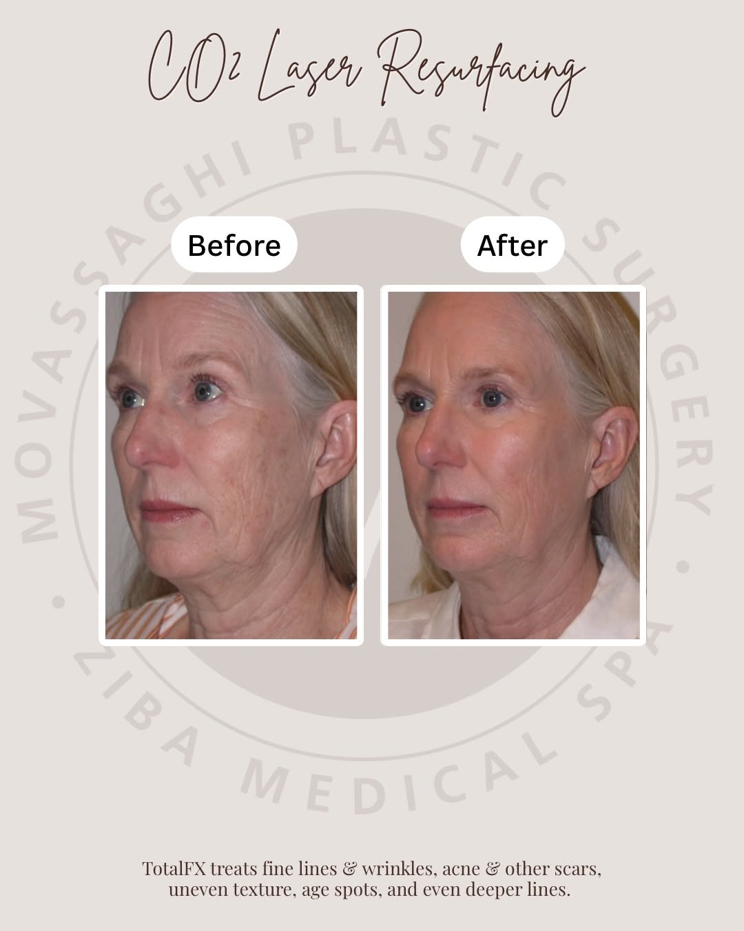 Instagram post by Dr. Kiya Movassaghi: Improving the fabric of her skin prior to her Deep Plane Facelift🤍 This patient underwent a CO2 Fractional laser to treat hyperpigmentation…