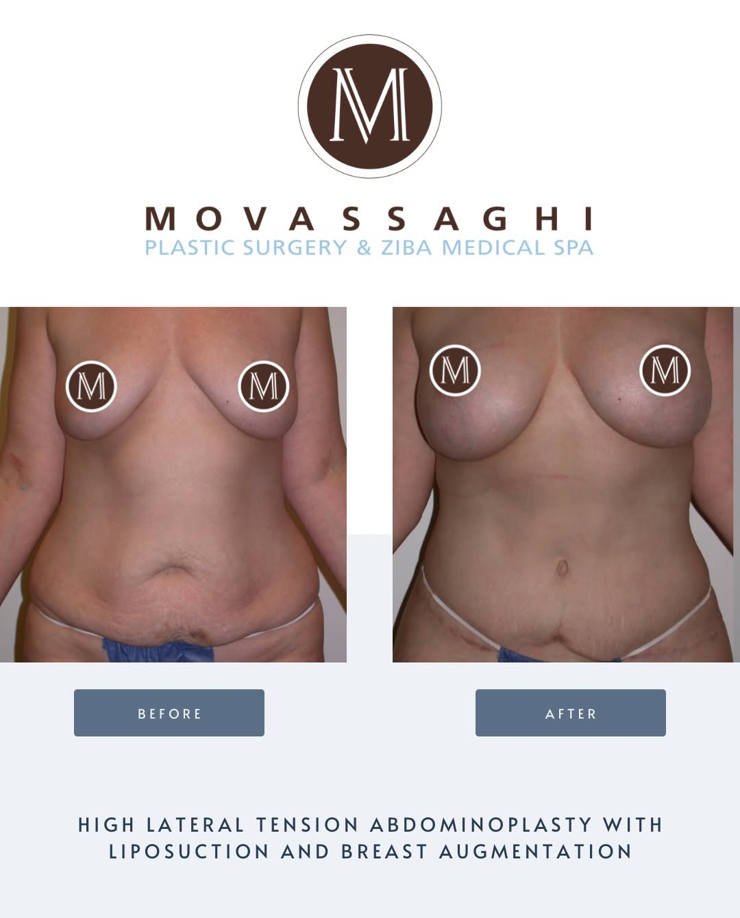 Instagram post by Dr. Kiya Movassaghi: A mommy makeover can help you address unwanted changes to your breasts and body following pregnancy and childbirth, dramatically improving y…