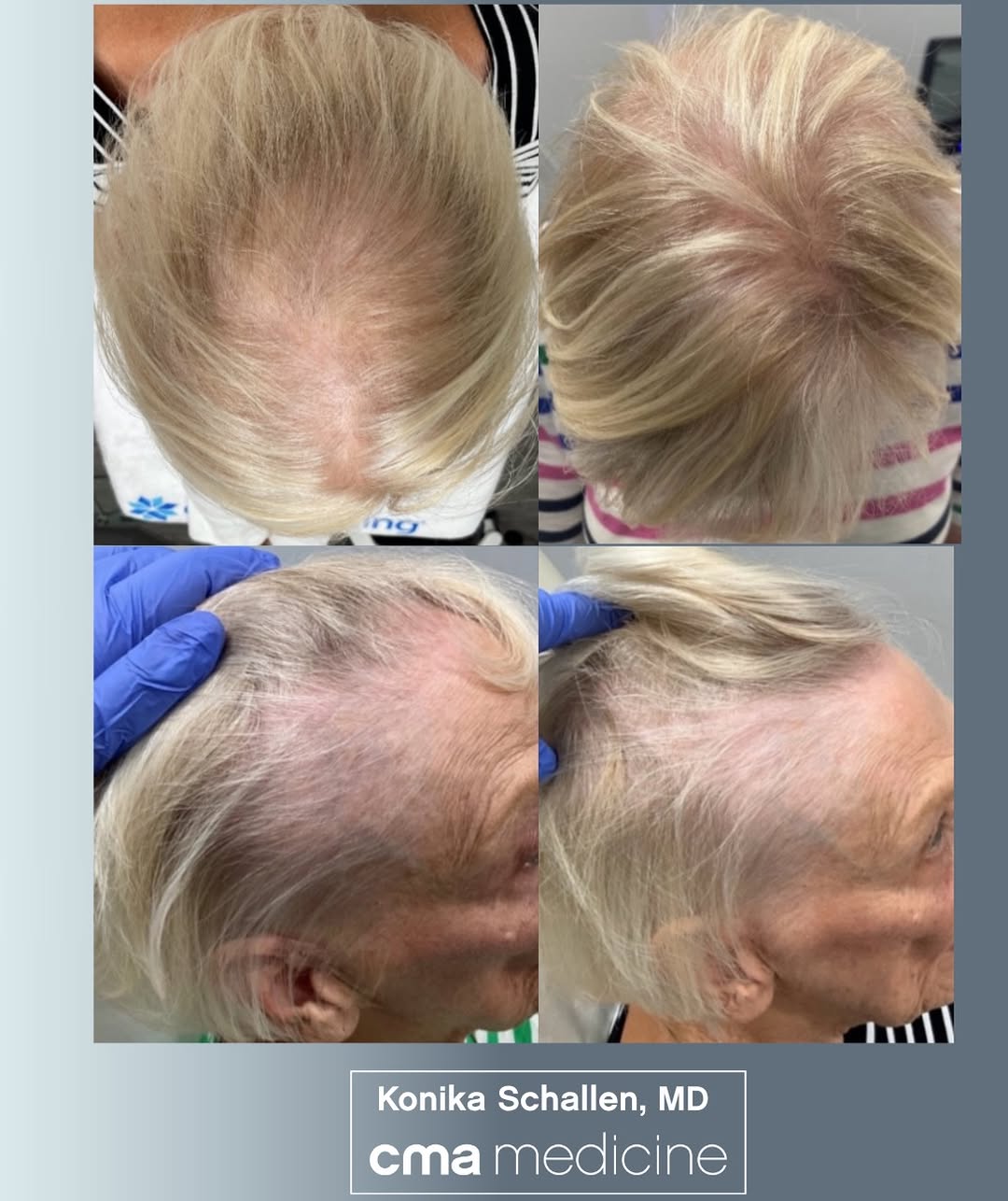 Instagram post by Dr. Konika Patel Schallen: Hair restoration is evolving and at @cmamedicine, we take a regenerative approach. Hair loss can happen for a variety of reasons, which is w…