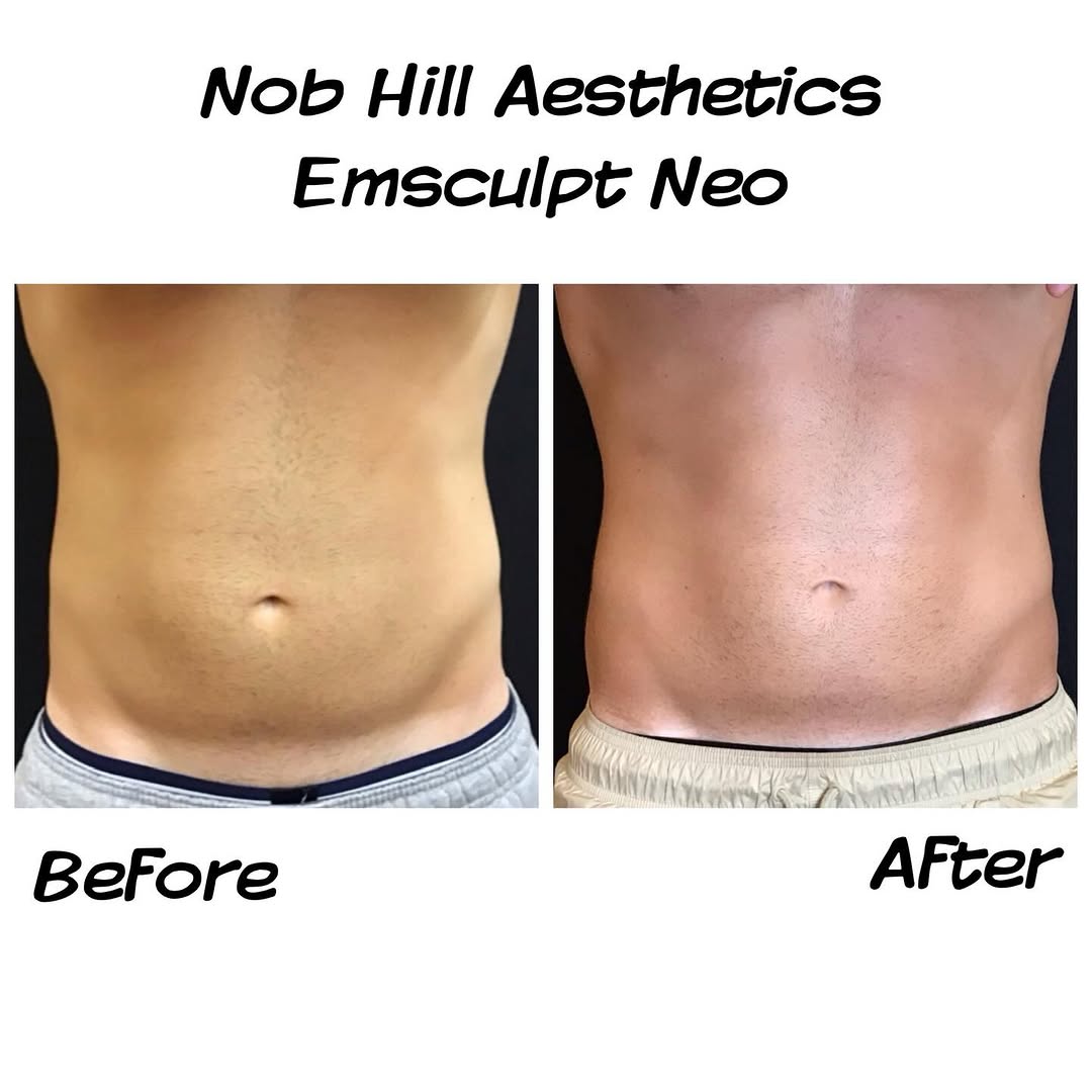 Instagram post by Dr. Konstantin Bukov: Before ➡️ After Stronger. Tighter. More sculpted. This is what Emsculpt NEO can do. 💥 Non-invasive muscle building and fat reduction with r…