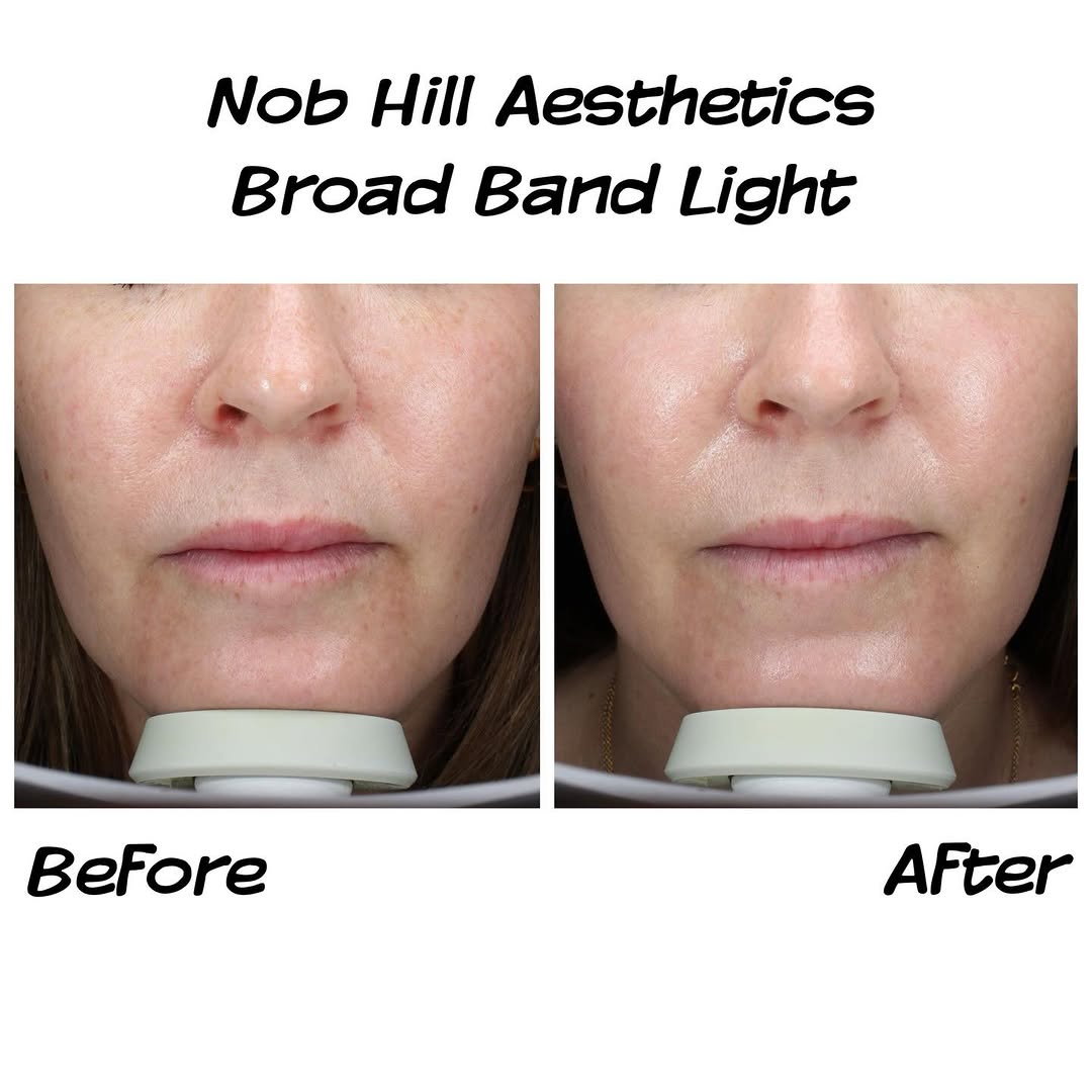 Instagram post by Dr. Konstantin Bukov: Say hello to brighter, clearer skin ✨ BBL helps target sun damage, redness, and uneven tone while stimulating collagen for long-term skin he…
