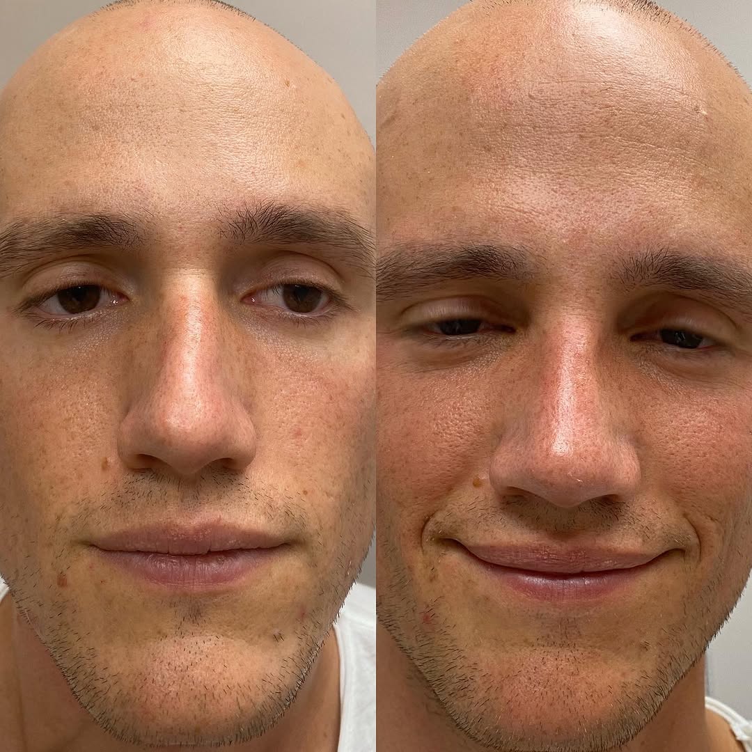 Instagram post by Dr. Konstantin Salkinder: Before and after reconstructive Rhinoplasty for severe nasal deformity