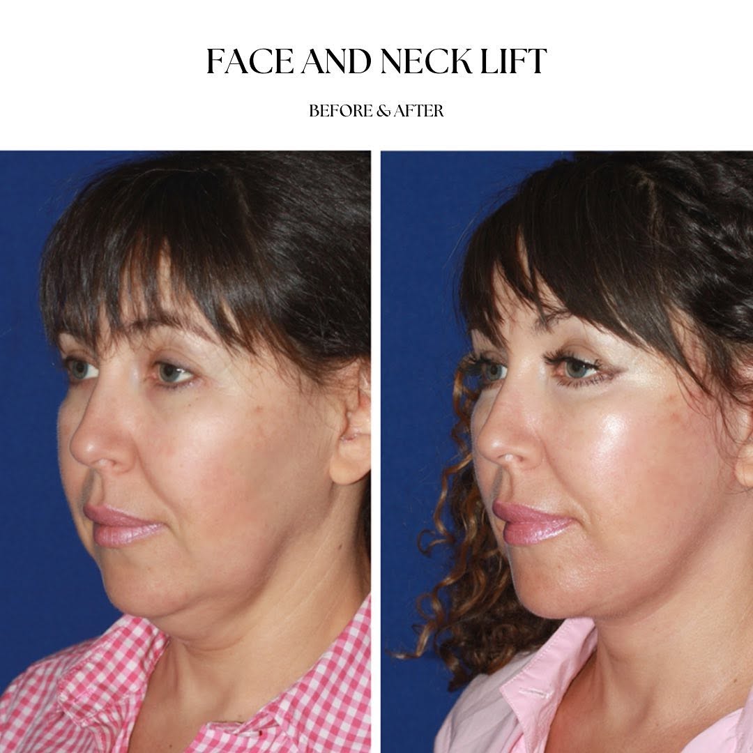 Instagram post by Dr. Konstantin Vasyukevich: Face and neck lift for my lovely and beautiful patient to smooth out the contour of the face, elevate the cheeks and remove excess skin unde…