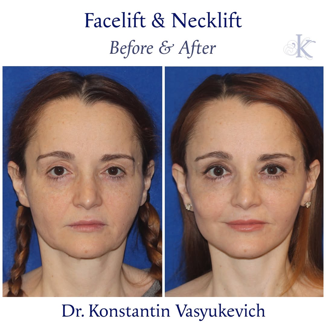 Instagram post by Dr. Konstantin Vasyukevich: A defined jawline and smooth neck contour emerge from the deep plane release, restoring balanced proportions and erasing the expressions of …