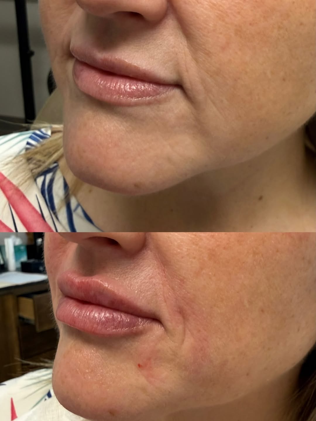 Instagram post by Dr. Kris Shewmake: With one syringe of Restylane we added soft volume and definition to the lips while also gently softening the nasolabial folds and corners o…