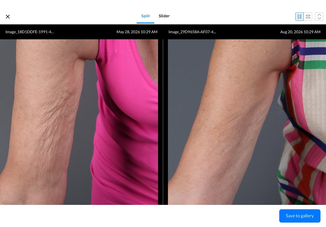 Instagram post by Dr. Kris Shewmake: These results are after @sofwavemedical treatment to the upper arms post, targeting skin laxity and helping stimulate new collagen for firme…