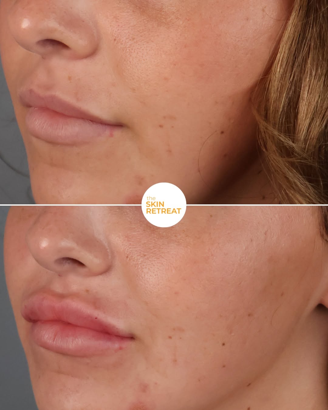 Instagram post by Dr. Kris Shewmake: A little goes a long way! 💋✨ This subtle lip enhancement was achieved with just ½ syringe of filler, adding soft volume and definition whil…