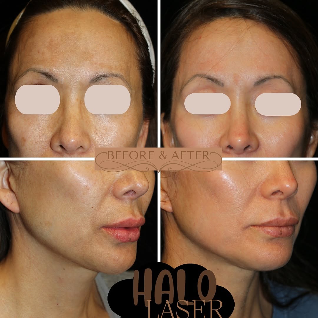 Instagram post by Dr. Krishna Dash: 3-4 days of social downtime for a lifetime of ‘wow, you’re glowing!’ ✨✨ The Halo isn’t just a filter, it’s the future of flawless skin. Bye-…