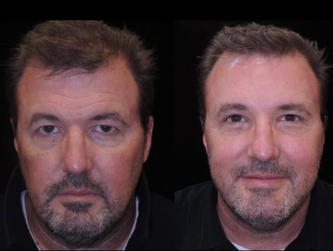 Instagram post by Dr. Kristin J. Tarbet: Upper Blepharoplasty + Endoscopic Brow Lift | 49-year-old male A tired or heavy upper eyelid appearance is often caused by both excess eyeli…