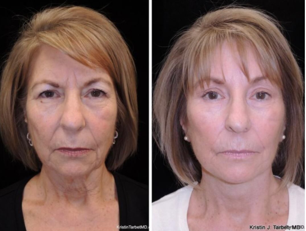 Instagram post by Dr. Kristin J. Tarbet: Subtle lift. Brighter eyes. Restored definition. ✨ This facial rejuvenation combines a facelift, blepharoplasty, and endoscopic browlift to …