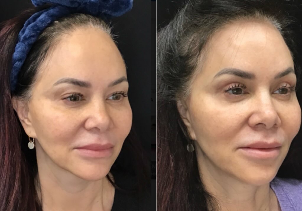 Instagram post by Dr. Kristin J. Tarbet: A subtle lift can create beautiful balance and rejuvenation. ✨ This surgical lip lift enhanced upper lip shape, improved tooth show, and cre…