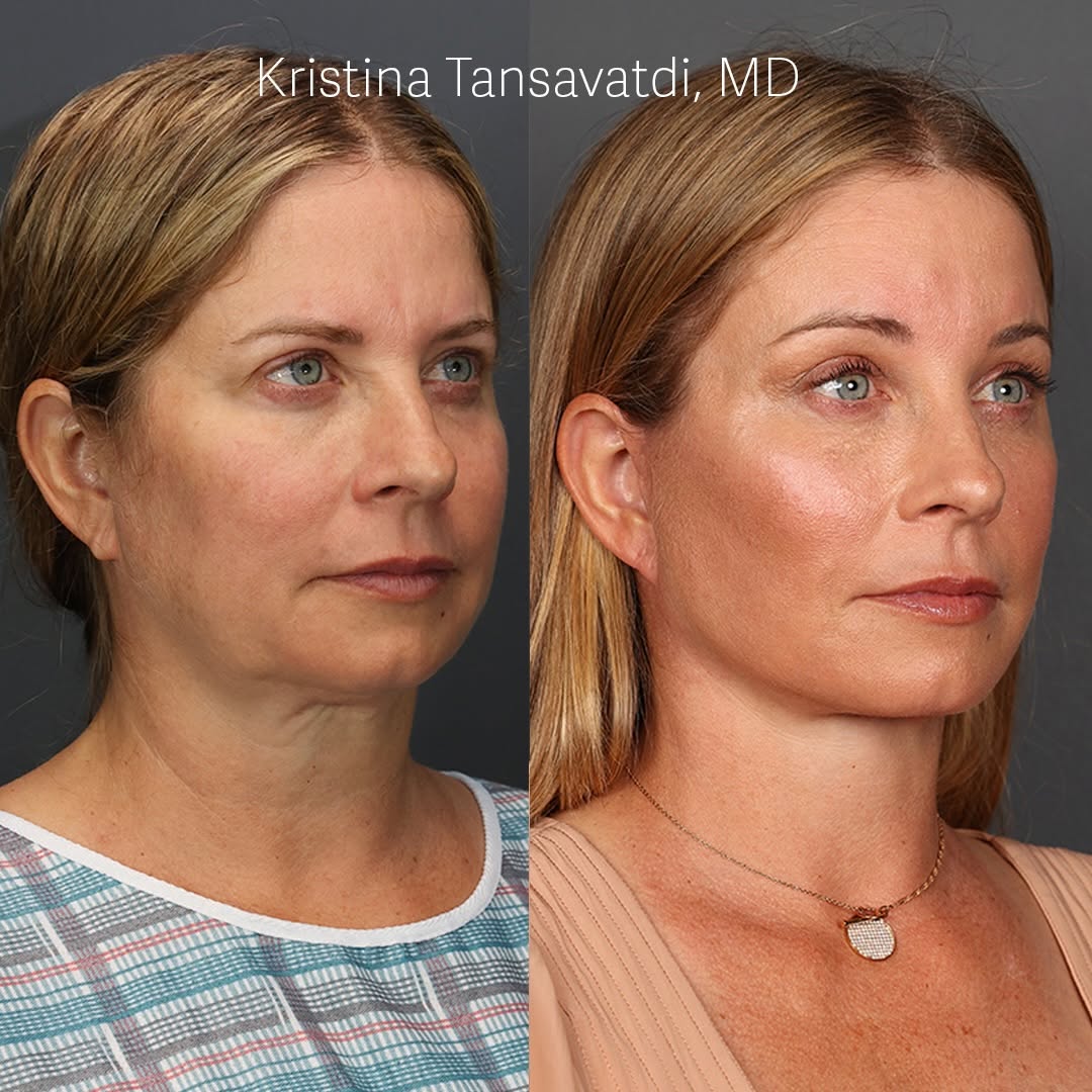 Instagram post by Dr. Kristina Tansavatdi: ✨ Deep Plane Facelift at 47 - Kendall’s Journey 🔥 One of the most common questions I hear is, “Am I too early to have a facelift?” Kendall’…