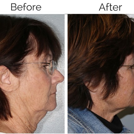 Instagram post by Dr. Kristy Faye Fleming: Another great success! Kybella literally dissolves away a double chin. No surgery, no downtime, no pain