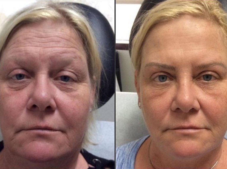 Instagram post by Dr. Kristy Faye Fleming: This amazing patient was treated with Botox to her forehead and crows feet, as well as Vollure, Volbella, and Voluma to replace facial volum…