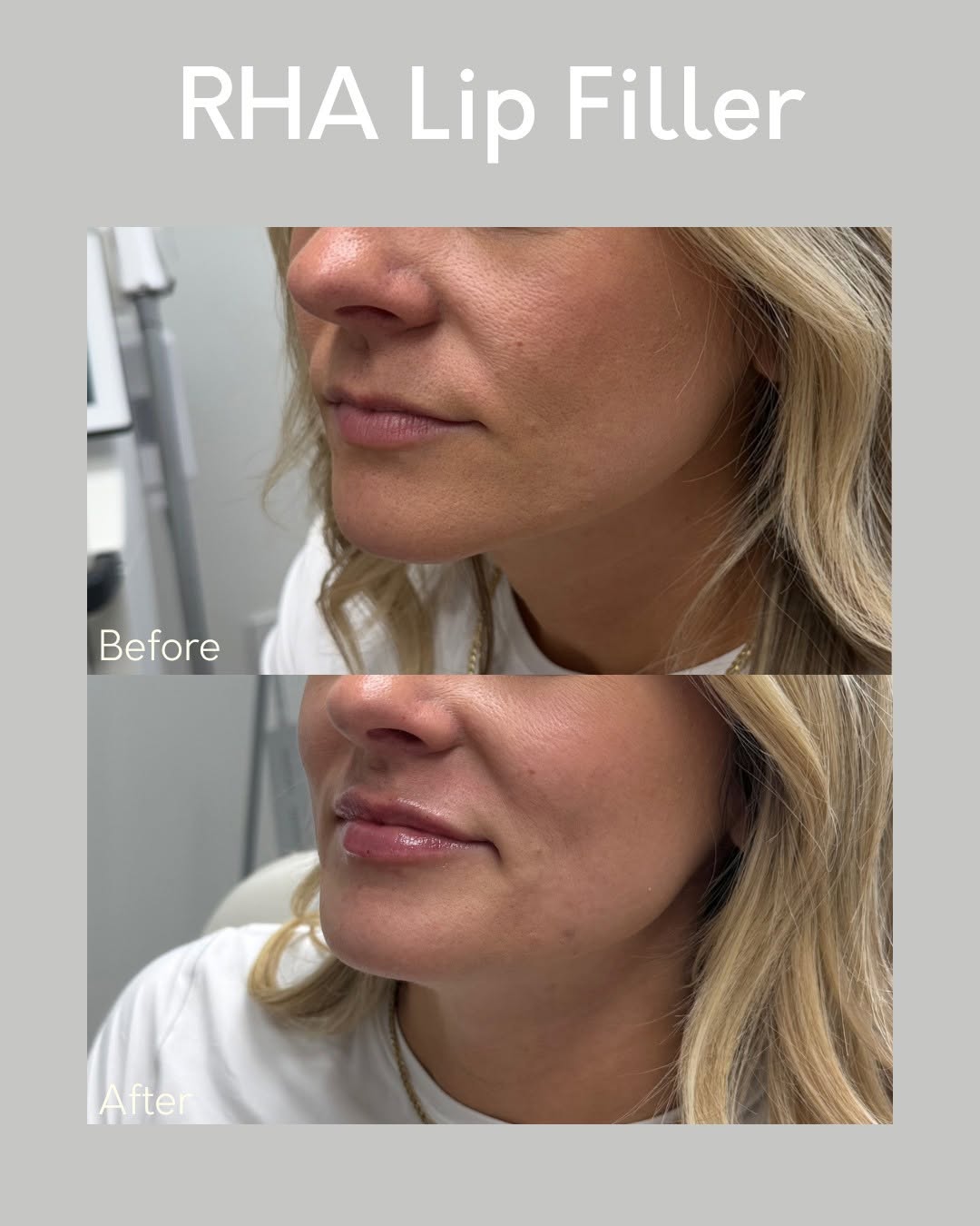 Instagram post by Dr. Kurtis Martin: #Cincinnati👄✨ Did you know lip filler can do more than just add volume? ✨👄 ✔️ Define your lip border ✔️ Smooth fine lines around the mouth…