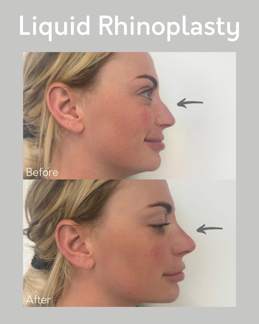 Instagram post by Dr. Kurtis Martin: ✨ Non-surgical confidence boost! ✨ Check out this stunning before & after of a liquid rhinoplasty. With just a few precise filler injections…