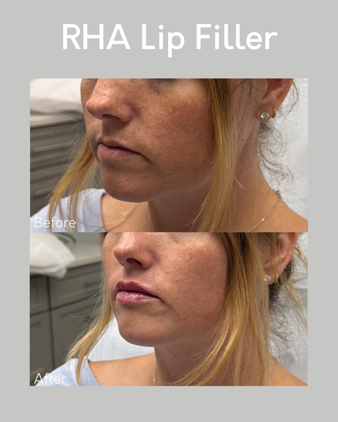 Instagram post by Dr. Kurtis Martin: 💋 Enhance your natural beauty with perfectly balanced lips! 💉✨ Our lip filler treatments are designed to add volume, define your shape, an…