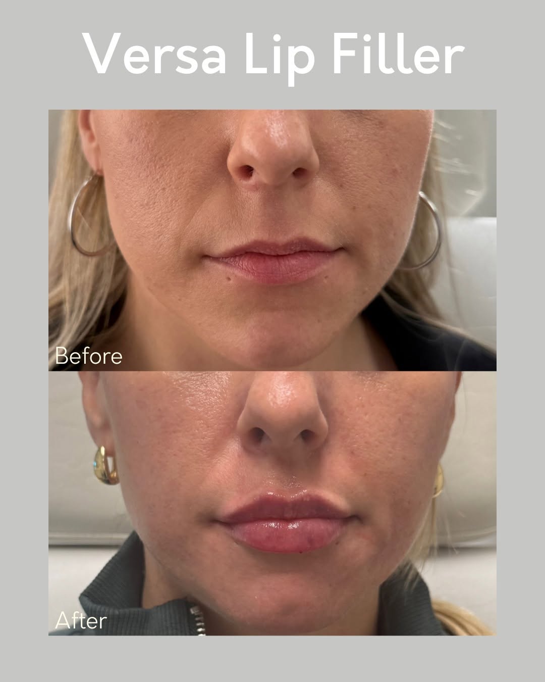 Instagram post by Dr. Kurtis Martin: 💋 Before & After: Versa Lip Filler 💋 Say hello to soft, natural-looking volume! Our Versa Lip Filler enhances your shape, defines your bor…