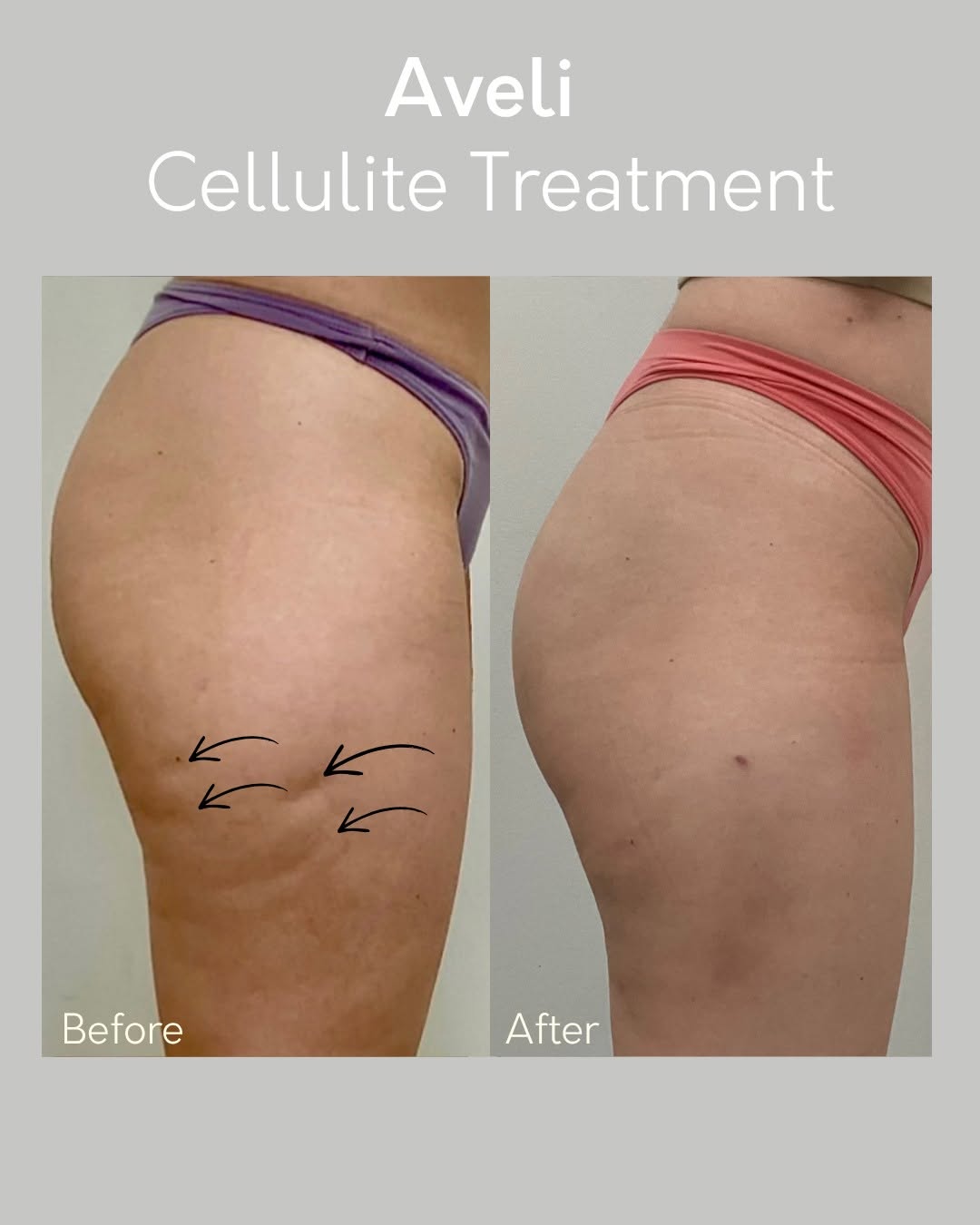 Instagram post by Dr. Kurtis Martin: Smooth skin just got even better. ✨ This Aveli before & after shows real improvement in cellulite by treating the root cause—not just the su…