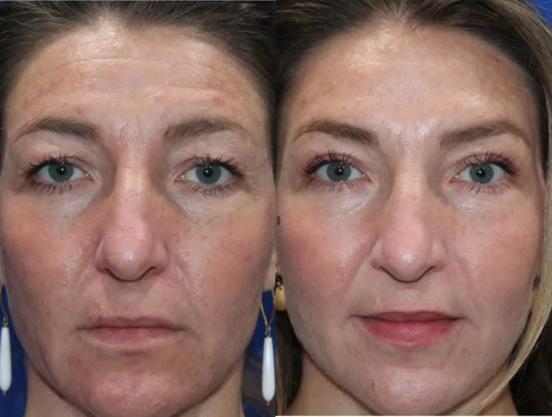 Instagram post by Dr. Kyle Cox: Smize ✨️ this patient is in her 40s and wanted a little refresher. 40s is the decade where we often can appreciate more tangible changes. Up…