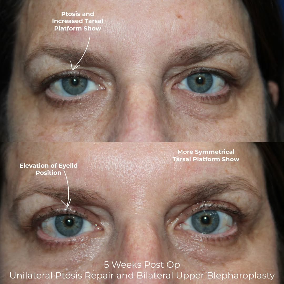 Instagram post by Dr. Kyle Cox: Another example of unilateral ptosis—often noticed as eyelid asymmetry or what patients may describe as a “lazy eye” appearance. Here, ptosi…
