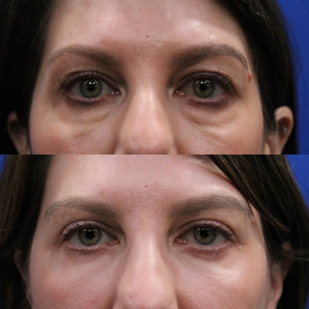 Instagram post by Dr. Kyle Cox: It’s rarely just one thing. 👁️ When we look at the aging eye, what we see is often the combination of several subtle—and anatomically disti…