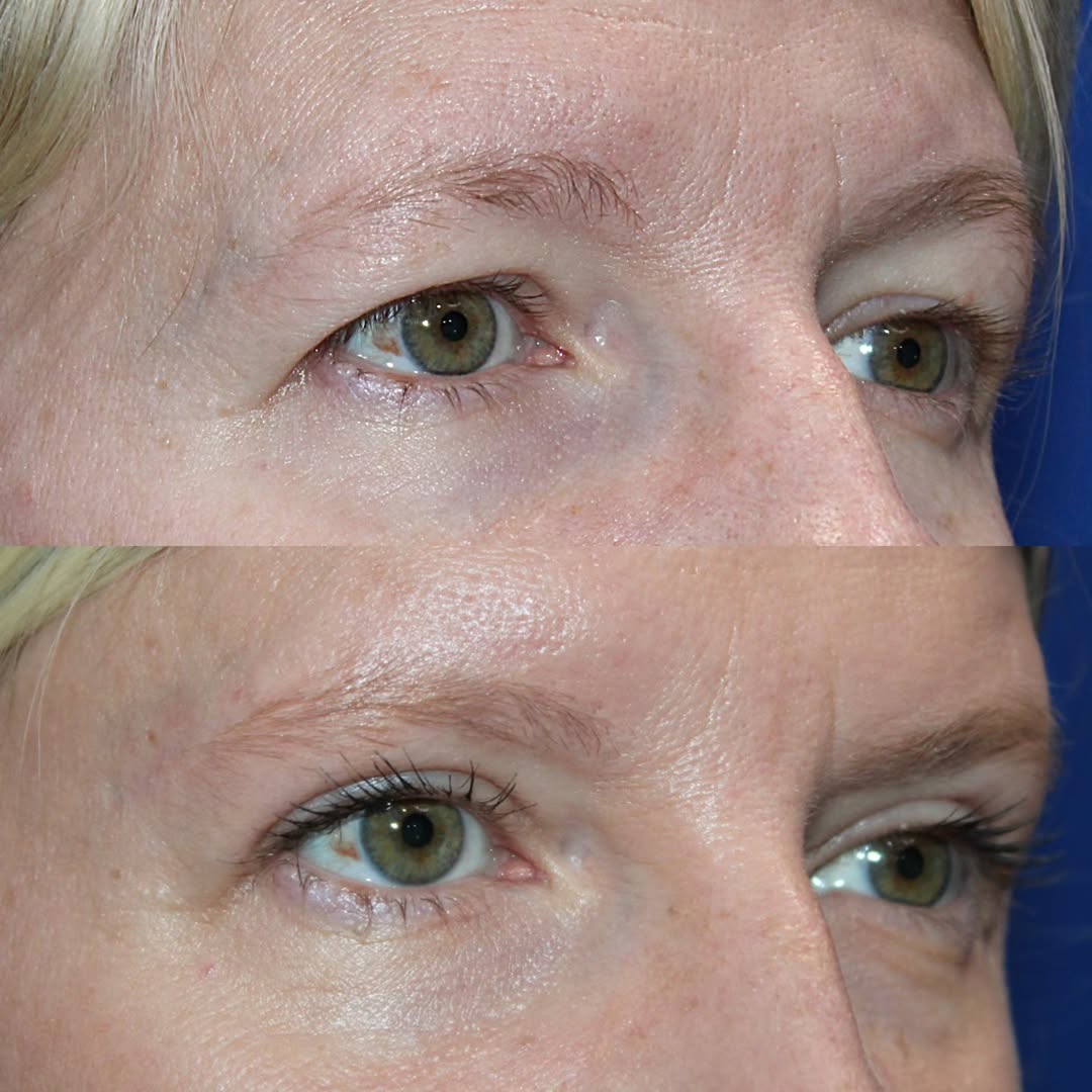 Instagram post by Dr. Kyle Cox: Smize Activated. A beautiful result--- let's learn about the evolution along the way... This patient underwent an upper blepharoplasty with …