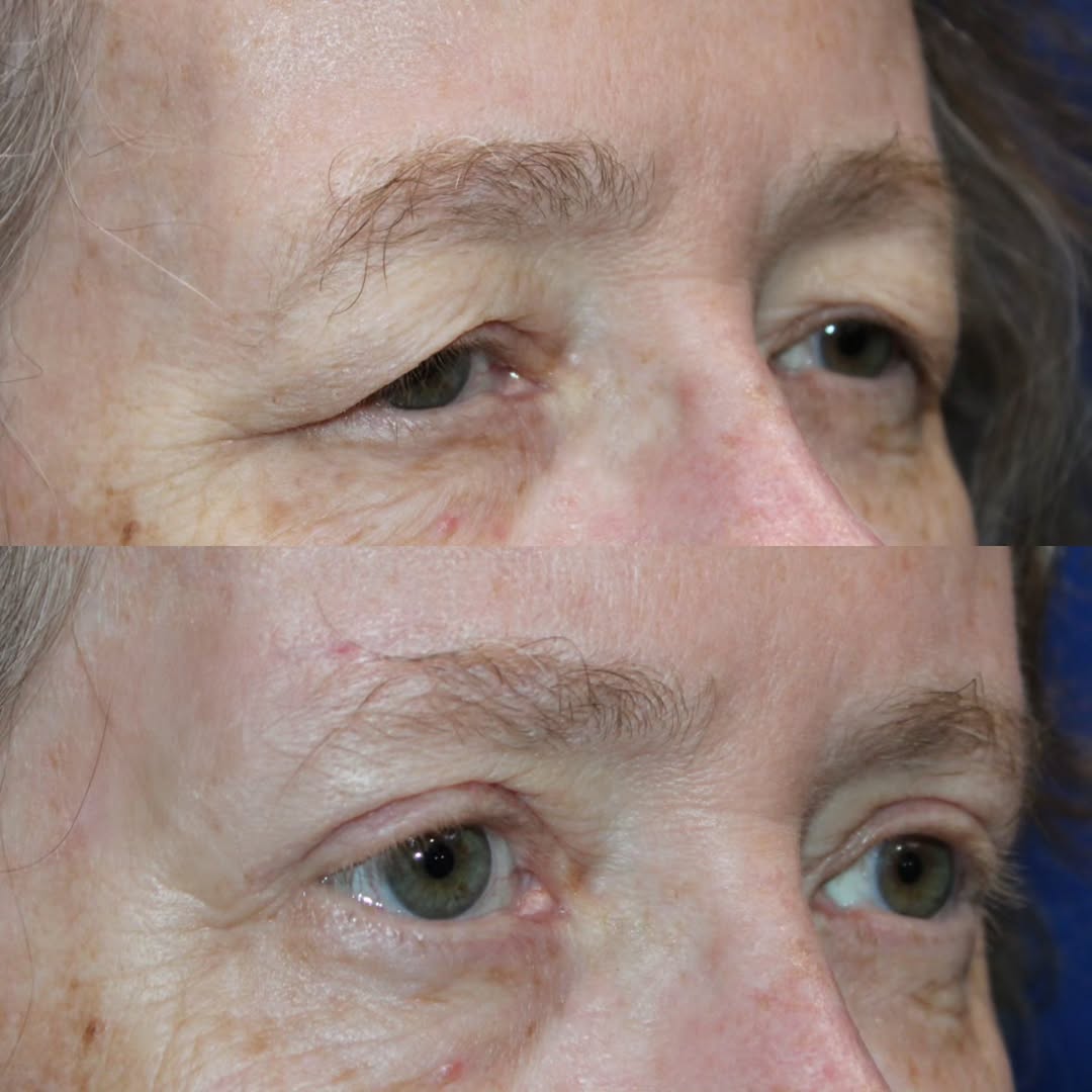 Instagram post by Dr. Kyle Cox: Function + Aesthetics 👁️✨ Sometimes a “heavy” upper eyelid is more than just excess eyelid skin. This patient had both upper eyelid dermato…
