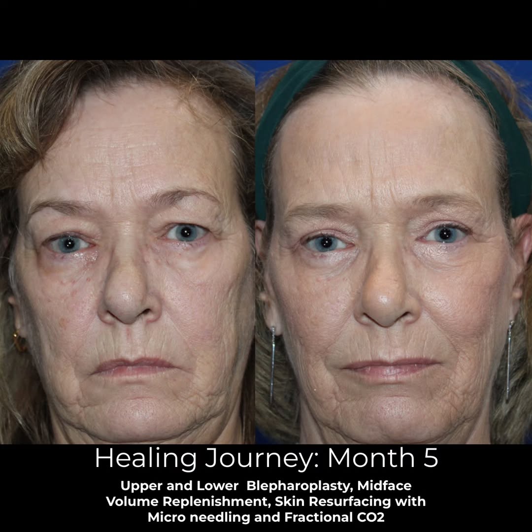 Instagram post by Dr. Kyle Cox: 5 months after comprehensive eyelid + facial rejuvenation ✨ Sometimes the most natural rejuvenation comes from recognizing that facial aging…