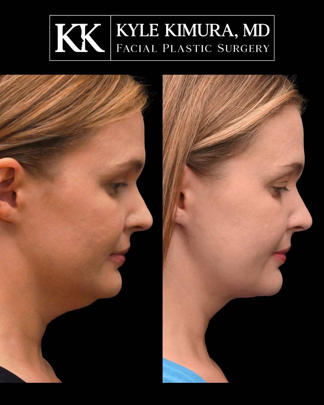 Instagram post by Dr. Kyle Kimura: 1 month after in-office chin liposuction + skin tightening Excited to share these results for this wonderful patient, now 1 month out from i…