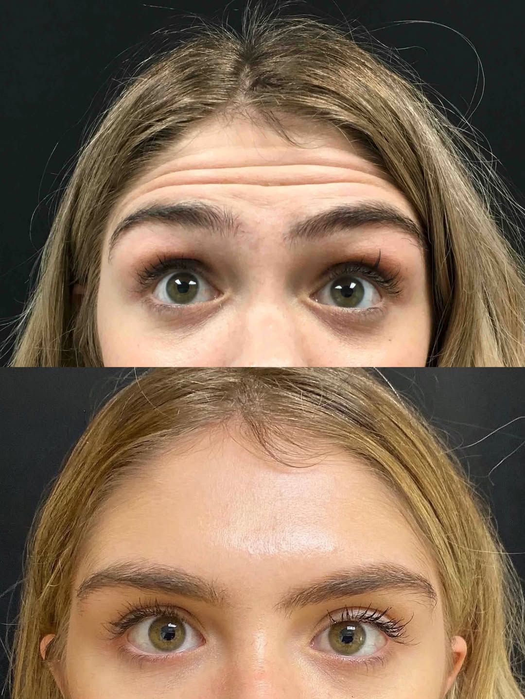 Instagram post by Dr. Laleh Shaban: Forehead lines, smoothed to nothing ✨ This is baby Botox at its finest. Soft, natural movement with zero heaviness 💉 Injector: Kerry, TRN @…