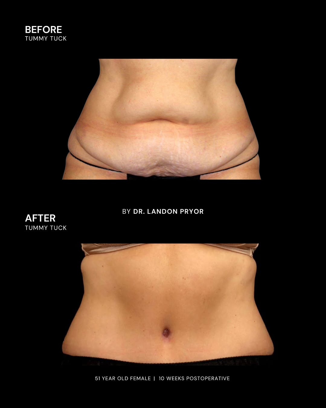 Instagram post by Dr. Landon Pryor: 10 weeks post-op and the waist is doing exactly what it needed to do. This 51-year-old patient is shown before and after her tummy tuck with…