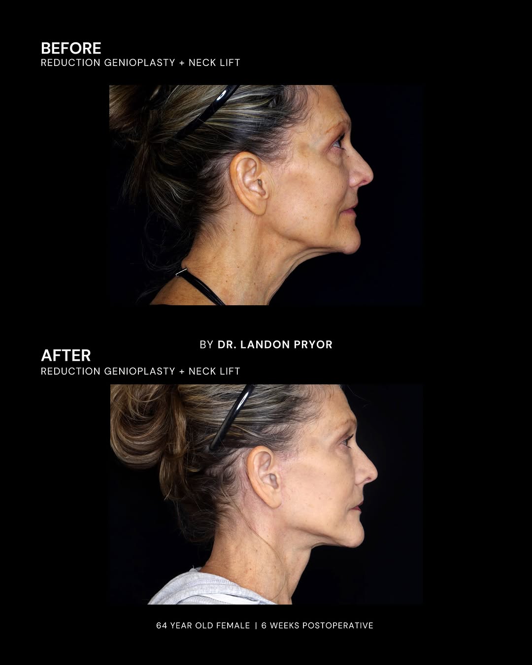 Instagram post by Dr. Landon Pryor: When treating the profile, it is not always about just one area. For this patient, a reduction genioplasty and neck lift were combined to re…