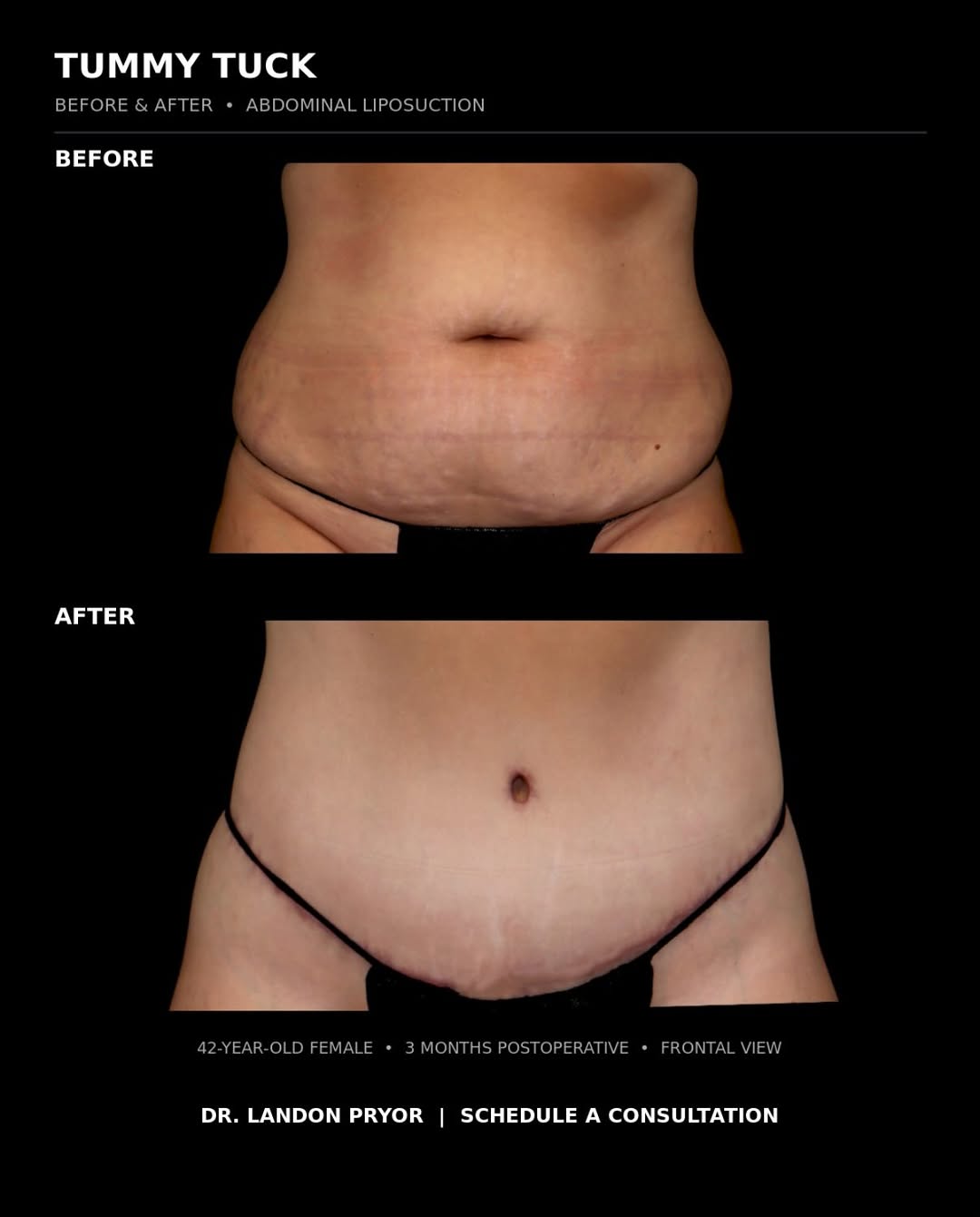 Instagram post by Dr. Landon Pryor: 42 year old female shown before and 3 months after a tummy tuck with abdominal liposuction performed by Dr. Landon Pryor. Ready for your tra…