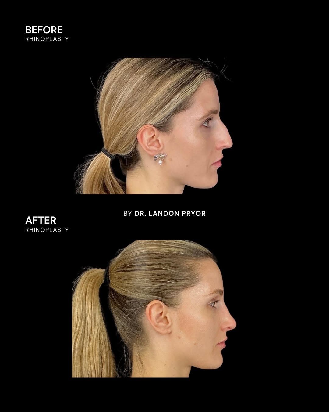Instagram post by Dr. Landon Pryor: A side profile worth a second look. This rhinoplasty created a smoother bridge and more defined tip for a beautiful profile transformation.