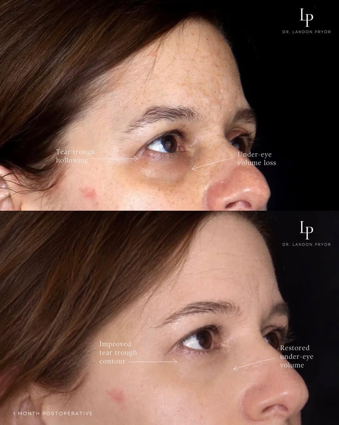 Instagram post by Dr. Landon Pryor: The goal was never to change her eyes. It was to restore softness beneath them while keeping her features completely her own. #fattransfer #…