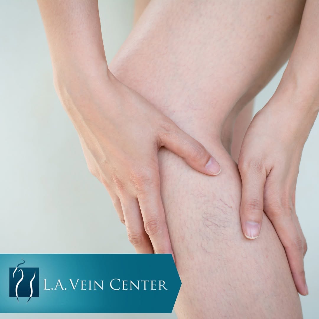Instagram post by Dr. Larisse K. Lee: Approximately half of the women in America struggle with the appearance of spider veins. However, this problem is not experienced by just wo…