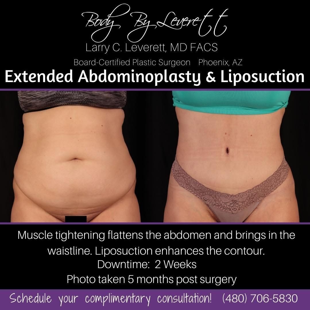 Instagram post by Dr. Larry C. Leverett: Patient is summer body ready this year! Dr Leverett has delivered another amazing result. Call and schedule a consultation to discuss your g…