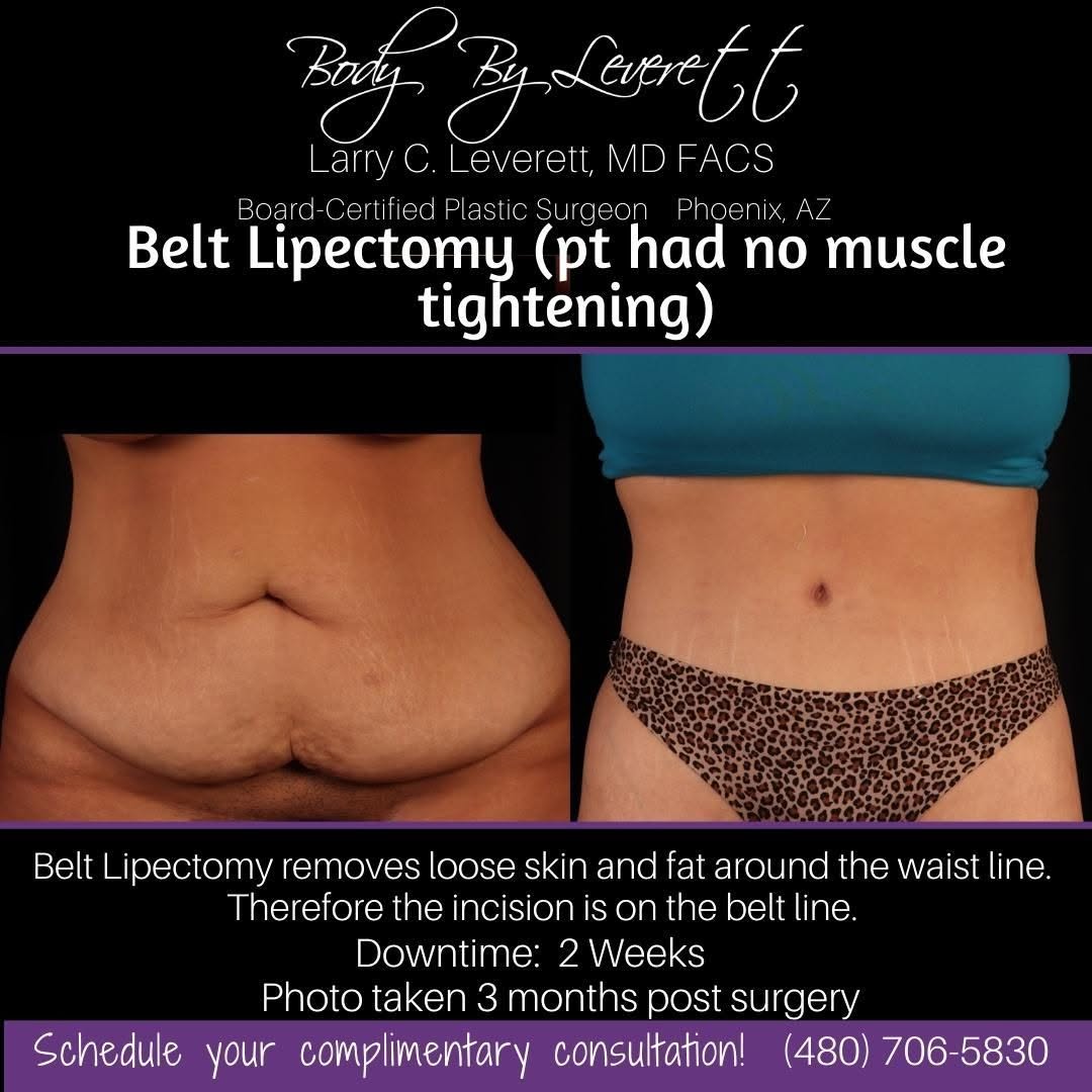 Instagram post by Dr. Larry C. Leverett: Schedule your consultation with Board Certified Plastic Surgeon, Larry C Leverett MD today to discuss your goals for the summer! Patient is …